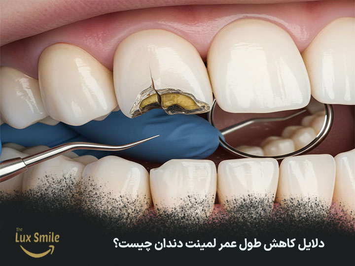 کاهش طول عمر لمینت دندان