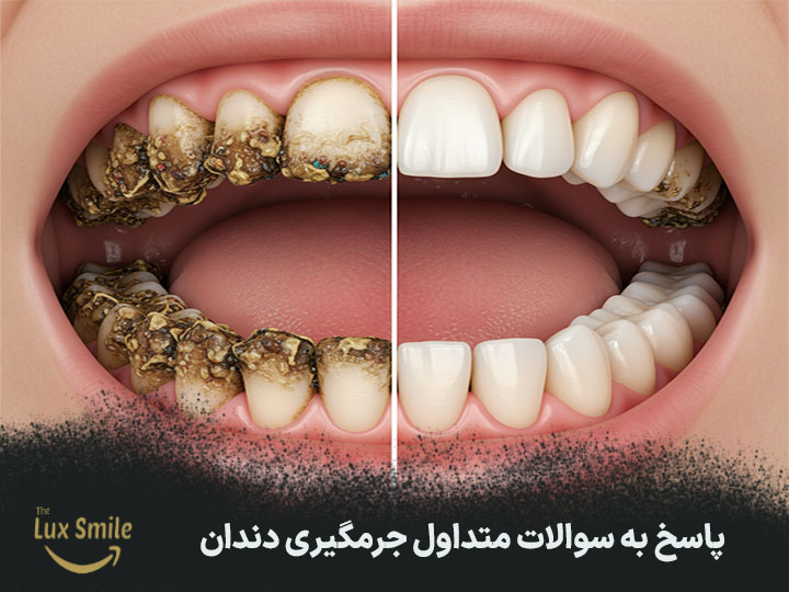 جرمگیری دندان در دندانپزشکی