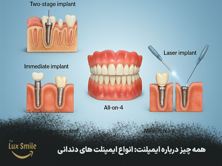 همه چیز درباره ایمپلنت