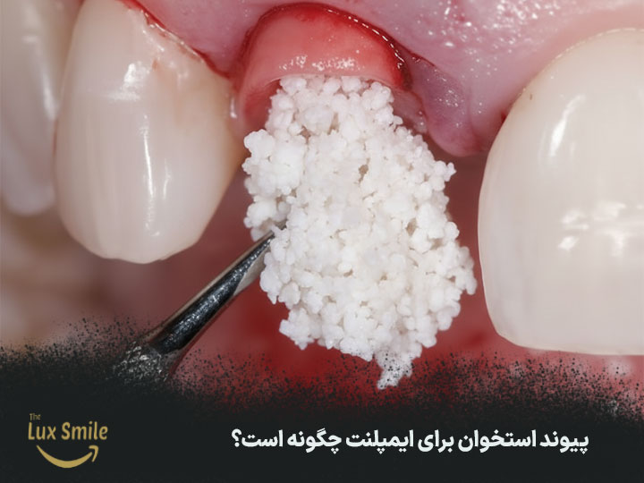 منظور از پیوند استخوان در ایمپلنت چیست